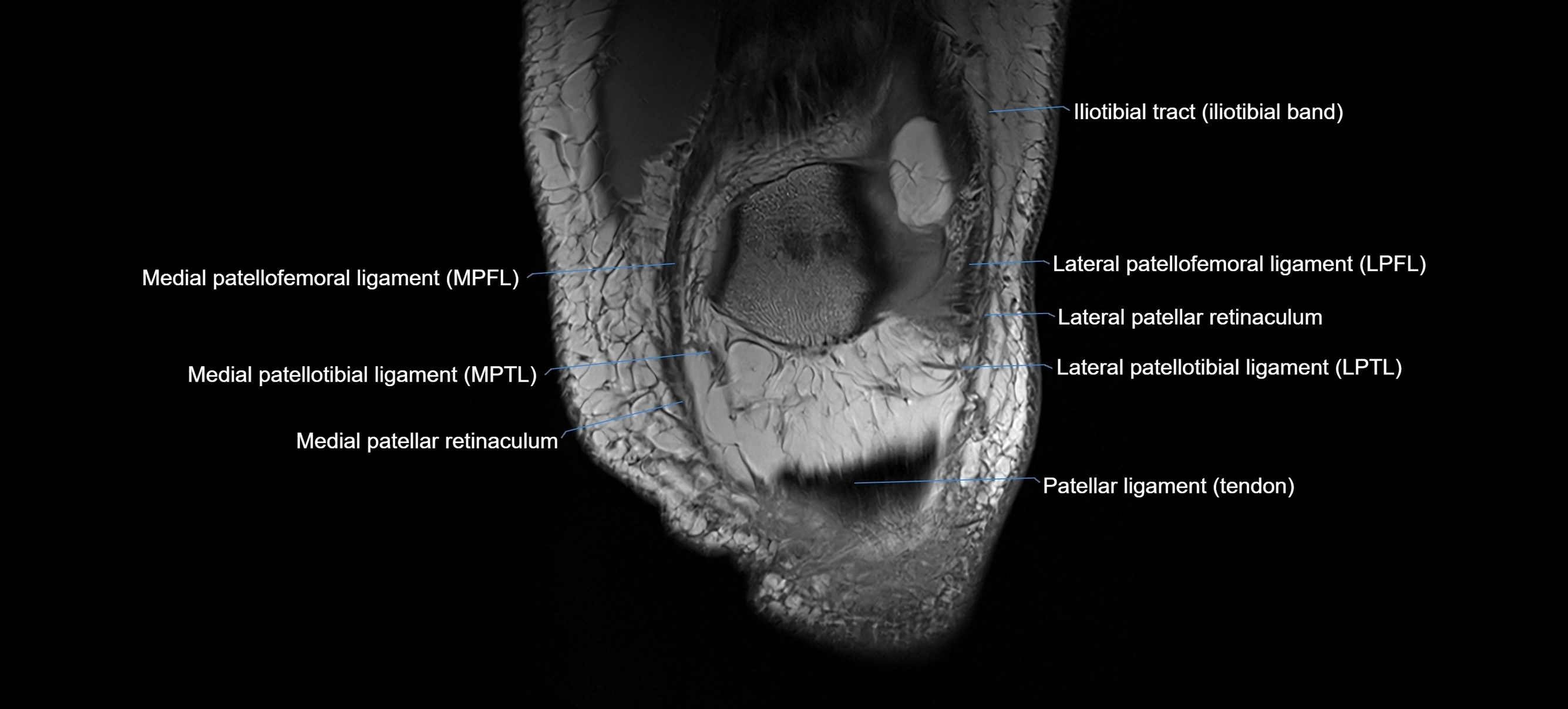 MRI coronal  ligaments cross sectional anatomy 3T  radiology  image-img-04001-00007.webp